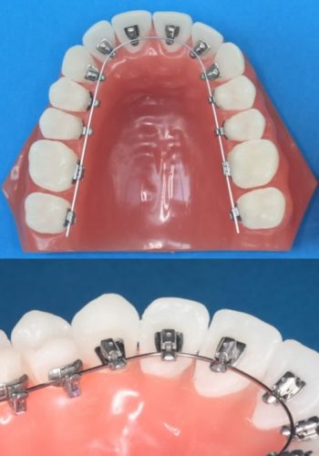 進化するストレートワイヤー | イーライン矯正歯科